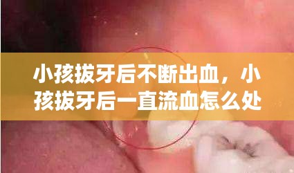 小孩拔牙后不断出血,小孩拔牙后一直流血怎么处理
